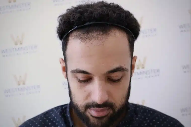 Top view of a male patient with curly hair showing a visible thin crown area mapped for procedure