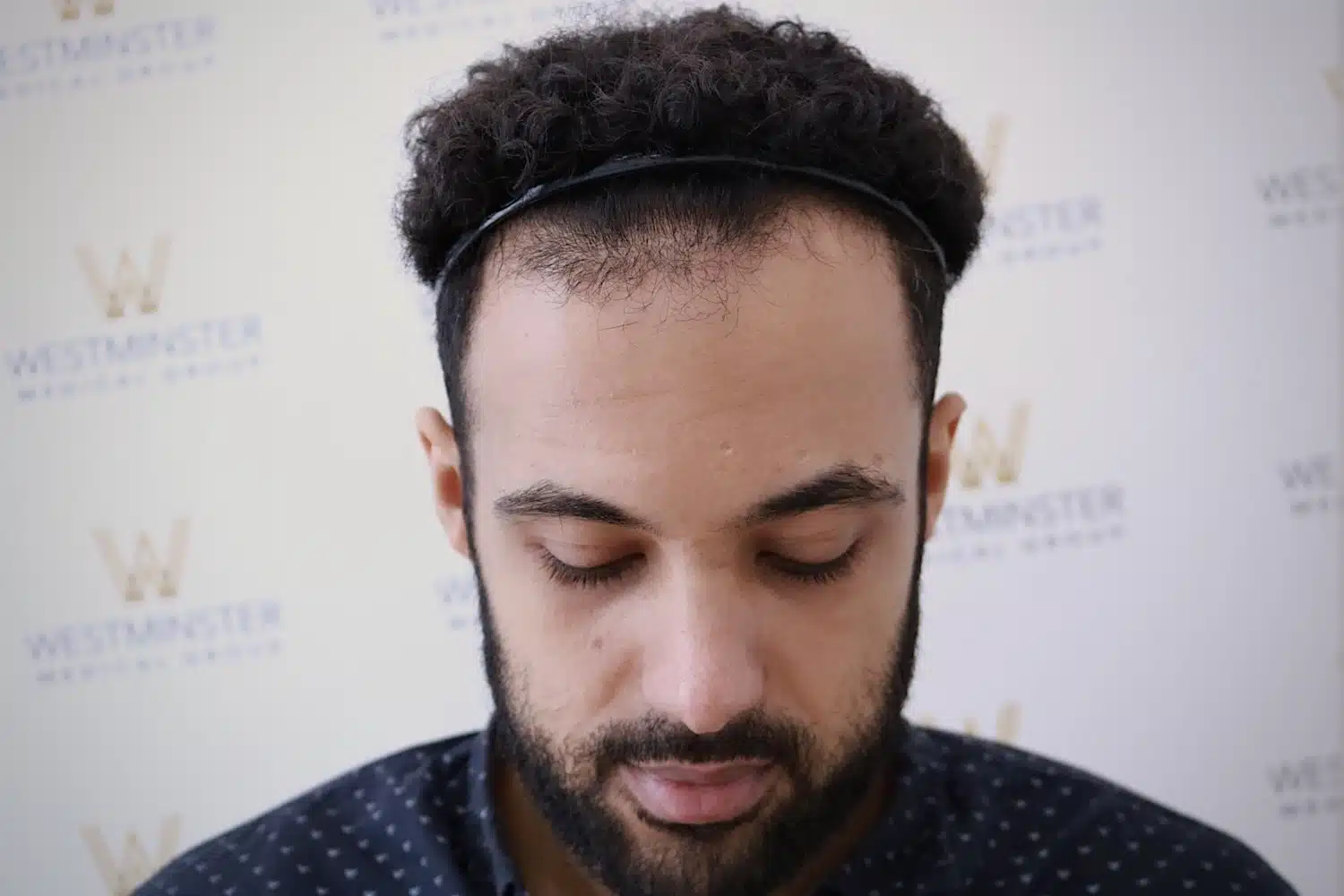 Top view of a male patient with curly hair showing a visible thin crown area mapped for procedure